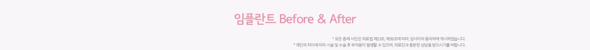 임플란트Before&After